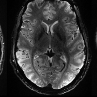 Самый мощный аппарат МРТ сделал первые снимки мозга